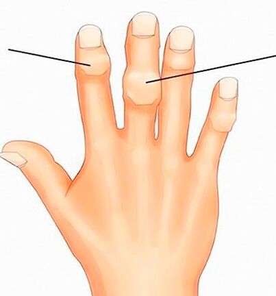 Heberden- und Bouchard-Knötchen an Interphalangealgelenken bei Arthrose