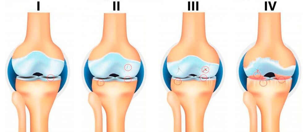 Stadien der Arthrose