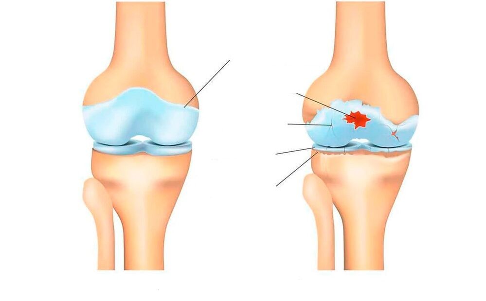 gesundes Gelenk und solche mit Arthrose