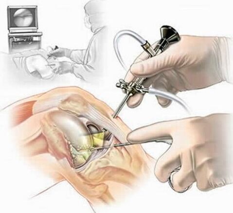 Betrieb am Gelenk der Knie -Arthroskopie