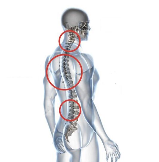 Wie sich Osteochondrose äußert